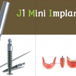 Cấy ghép mini Implant