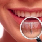 Implant giải pháp phục hồi răng hoàn hảo