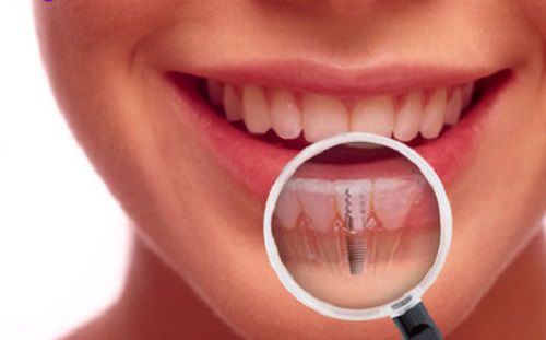  Implant giải pháp phục hồi răng hoàn hảo