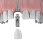 Implant khi mất một răng