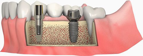 Implant nâng đỡ cầu răng 1