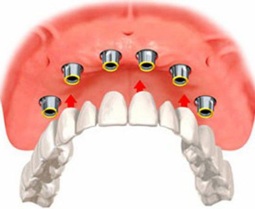 Implant nâng đỡ cầu răng