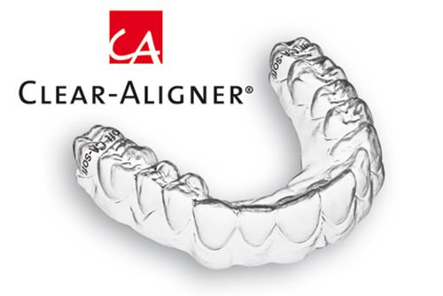 Niềng răng không mắc cài Clear Aligner giá bao nhiêu tiền?