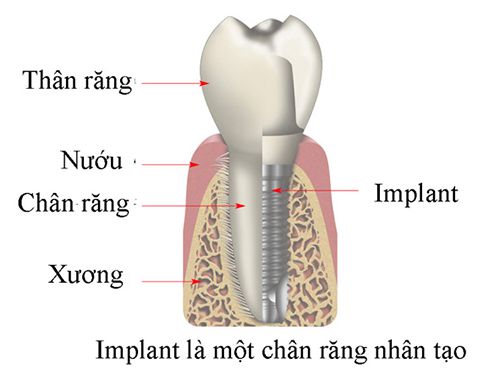 Ưu điểm vượt trội của cấy ghép răng Implant