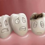 Bệnh lý sâu răng