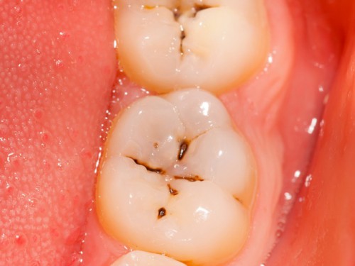 Bệnh lý sâu răng 2