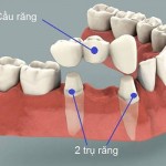 Cầu răng có phải là phương pháp trồng răng vĩnh viễn không?