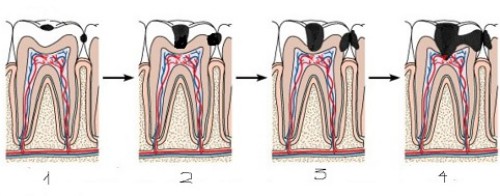 Các bước điều trị lấy tủy răng viêm