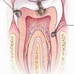 Phát hiện sâu răng sớm