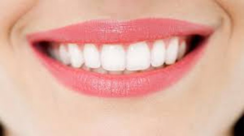 Tẩy trắng răng duy trì trong bao lâu? 3