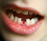 Nhổ răng hạn chế chấn thương trong chỉnh nha
