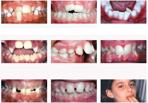 Tổng hợp các nguyên nhân khiến răng bị vẩu 3