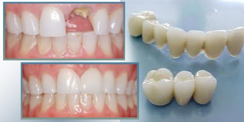 Biến chứng có thể xảy ra khi bọc răng sứ 5