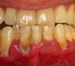 Nguyên nhân gây viêm tủy răng