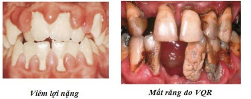 Các loại bệnh quanh răng thường gặp nhất 1