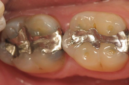 Chữa bệnh sâu răng cho trẻ em 4