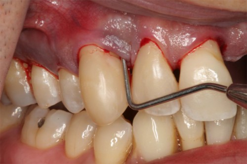 Cơ chế gây bệnh viêm quanh răng 