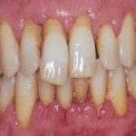 Cơ chế gây bệnh viêm quanh răng