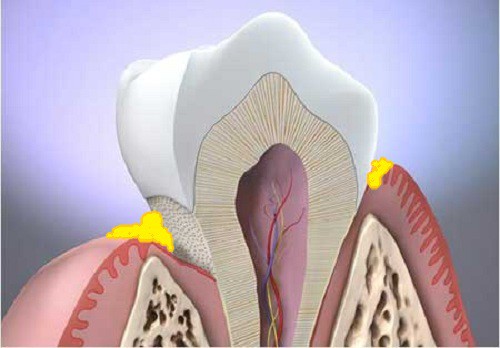 Các loại bệnh quanh răng thường gặp