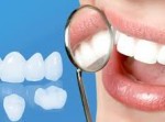 Phương pháp phục hình cầu răng