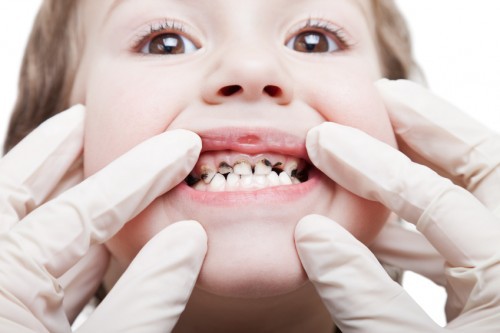 Tổng quan về bệnh sâu răng ở trẻ em 2