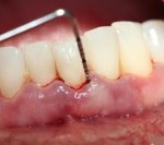 Các bước điều trị lấy tủy răng viêm