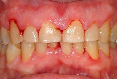 Các loại bệnh quanh răng thường gặp nhất 4