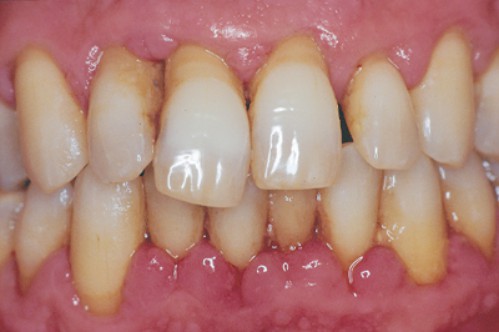 Các loại bệnh quanh răng thường gặp nhất 2