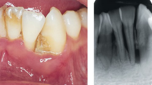Các loại bệnh quanh răng thường gặp nhất 3