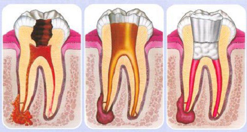 Nguyên nhân gây viêm tủy răng 3