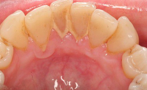 Các bệnh về răng miệng 4