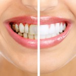 Những cách làm trắng răng tự nhiên nhanh nhất