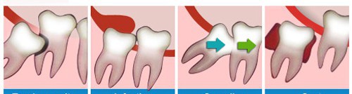 Nguyên nhân dẫn đến nhổ răng khôn 4