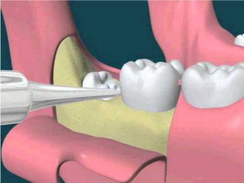 Nguyên nhân dẫn đến nhổ răng khôn 1