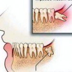Nhổ răng khôn có ảnh hưởng đến sức khỏe thần kinh
