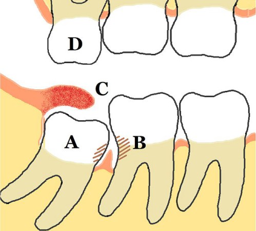 Nhổ răng khôn có ảnh hưởng đến sức khỏe thần kinh? 1