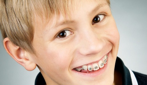 Niềng răng cho trẻ em và điều cần biết 3