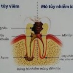 Quy trình điều trị tủy răng