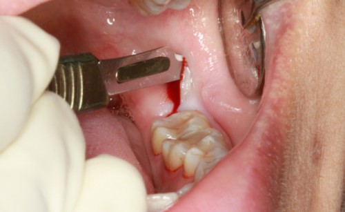 Răng khôn khi nào nên nhổ? 6