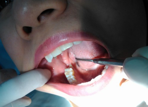 Răng khôn mọc lệch và các tác hại không lường trước được