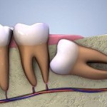 Qúa trình phục hồi sau khi nhổ răng khôn