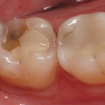 Các vấn đề về sâu răng