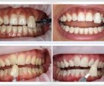 Có nên bọc răng sứ cho răng bị nhiễm Tetracycline