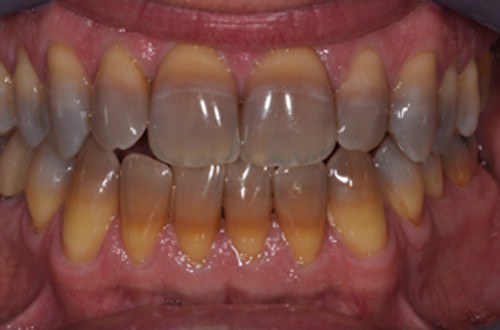 Có nên bọc răng sứ cho răng bị nhiễm Tetracycline? 1