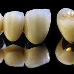 Hướng dẫn cách phân biệt các loại răng sứ