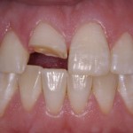 Những vấn đề răng miệng ở người cao tuổi