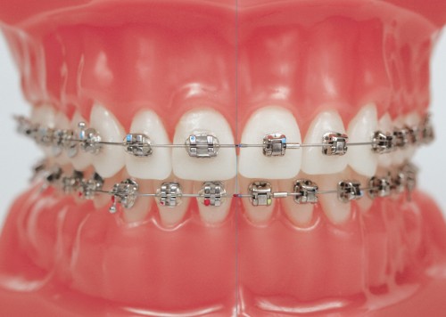 Các loại niềng răng nha khoa 