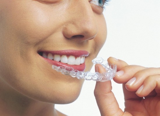 Các loại niềng răng nha khoa 4