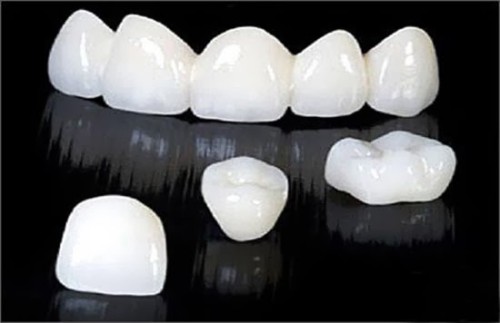 Răng sứ có ưu và nhược điểm gì? 3