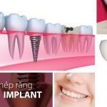 Trồng răng implant giá bao nhiêu ?